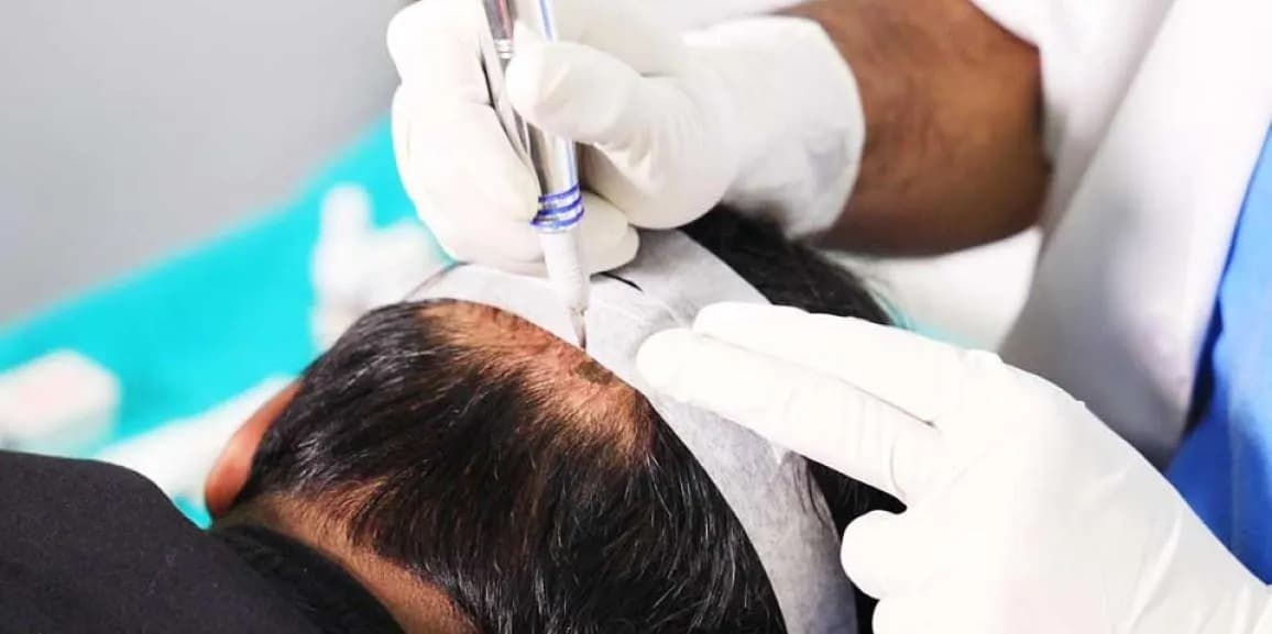 Sapphire Hair Clinic – Top Hair Transplant Istanbul Specialists